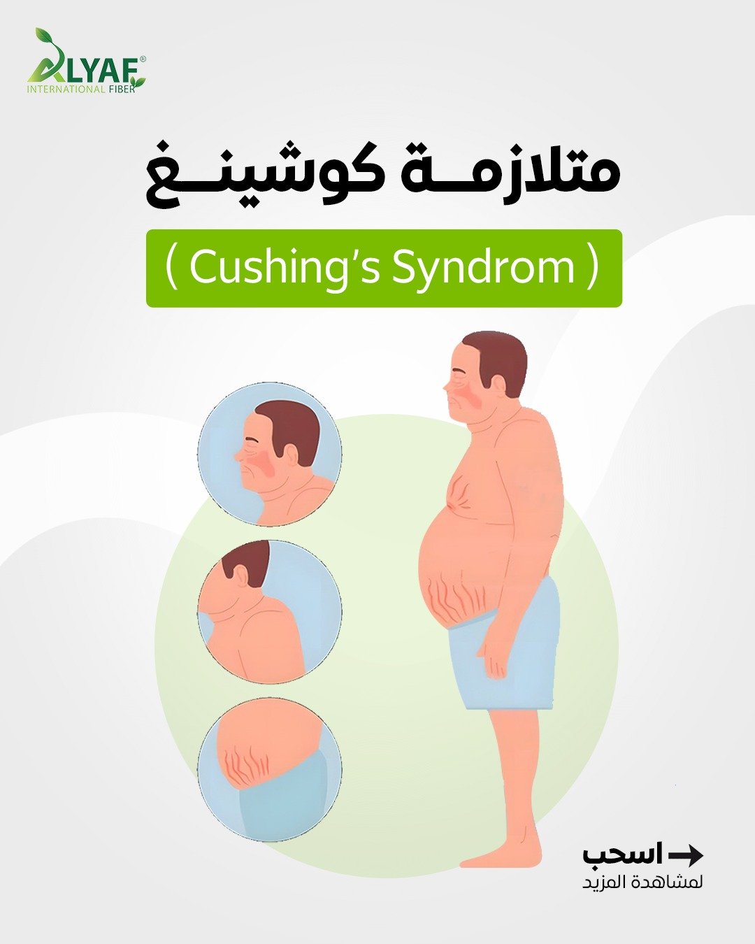 متلازمة كوشينغ (Cushing’s Syndrome)